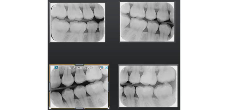 Bitewing bilateral