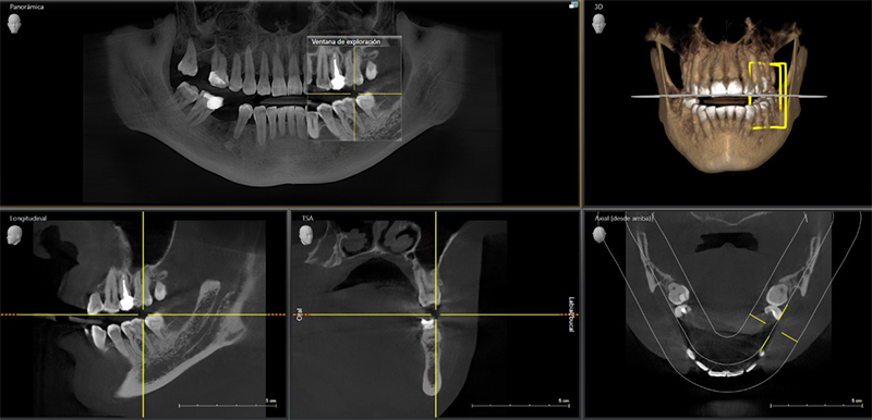 Cone beam 3D bimaxilar