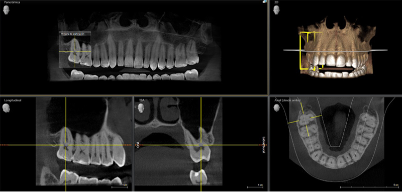 Cone beam 3D por maxilar