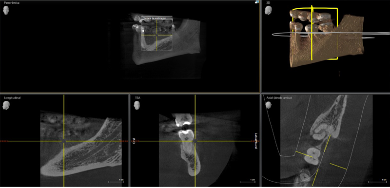 Cone beam 3D por zona