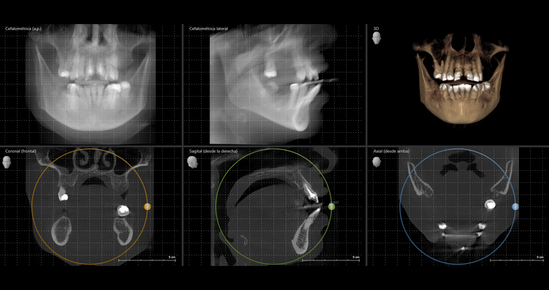 cbct bimax 02