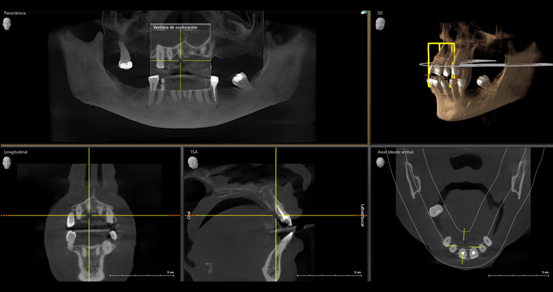 cbct bimax 03