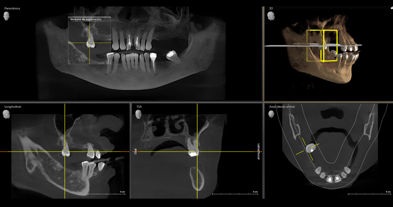 cbct bimax 05