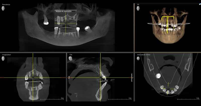 cbct bimax 06