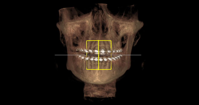 macizo facial 01