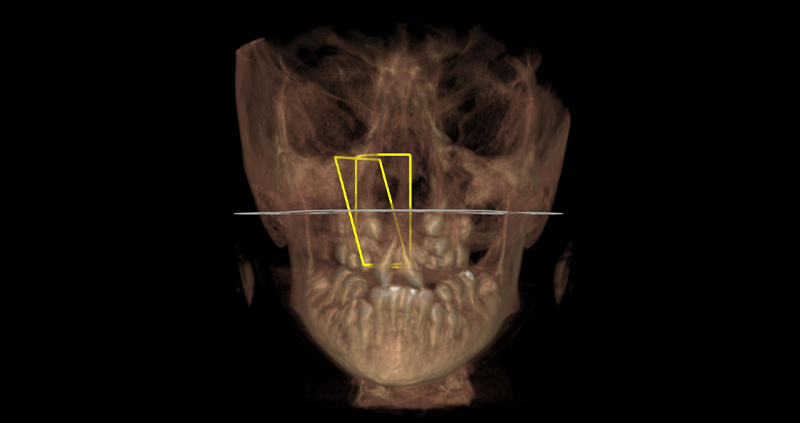 macizo facial 07