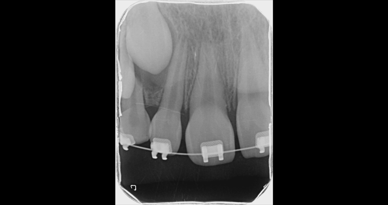 periapical 01