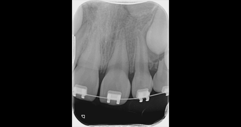 periapical 02