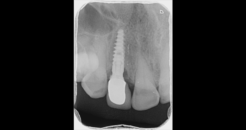 periapical 04