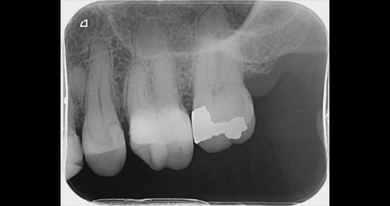 periapical 07