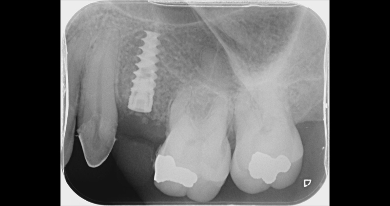 periapical 08