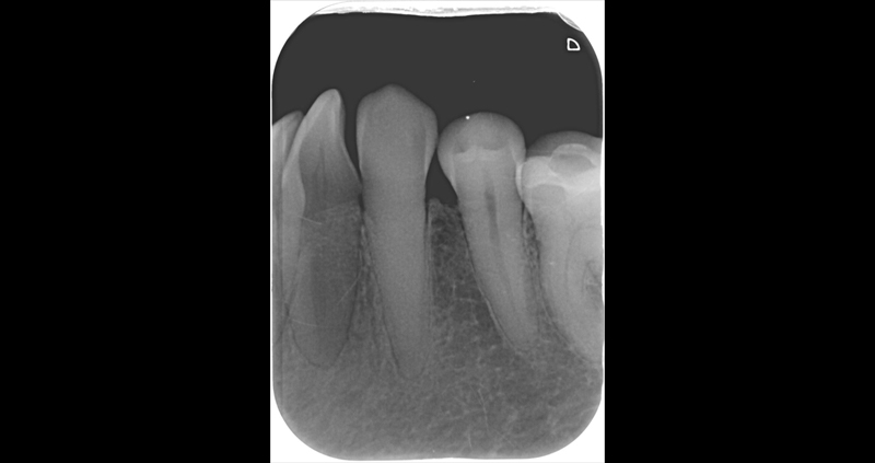 periapical 09