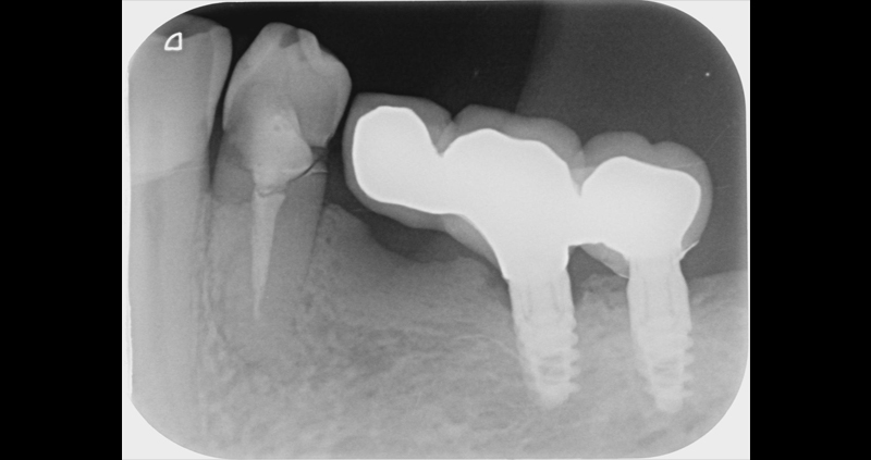 periapical 10